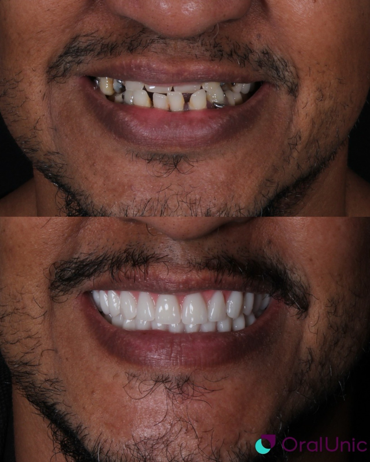 Resultado real de facetas de porcelana feitas pelo Dr. Eric Daldegan em Niterói